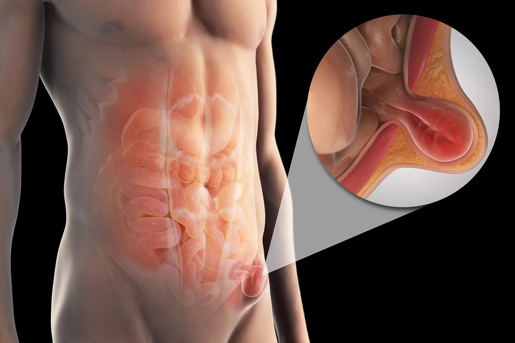 What is a Hernia Causes, Symptoms, Diagnosis, and Treatment